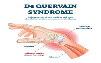 HỘI CHỨNG DE QUERVAIN: NHẬN BIẾT, CHẨN ĐOÁN VÀ PHƯƠNG PHÁP ĐIỀU TRỊ HIỆU QUẢ.