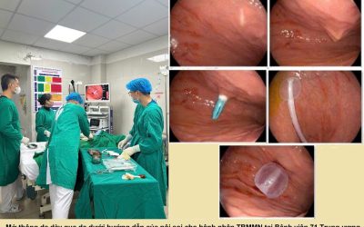 Mở thông dạ dày qua da dưới hướng dẫn nội soi (PEG): Chỉ định, quy trình và chăm sóc sau thủ thuật – Bệnh viện 71 Trung ương