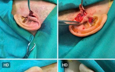 RÒ LUÂN NHĨ: DỊ TẬT BẨM SINH NHỎ NHƯNG CÓ THỂ GÂY BIẾN CHỨNG NẾU CHỦ QUAN